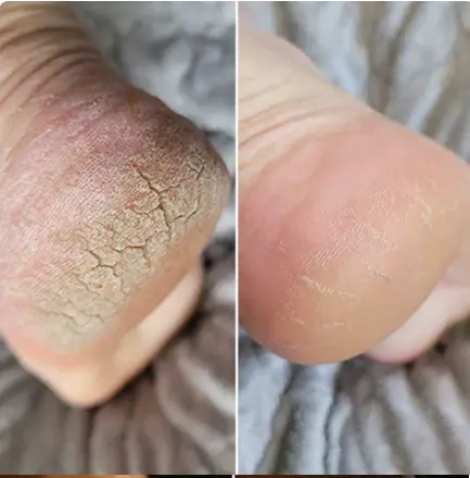 Min häl före och efter med Lovelle Smooth Pro