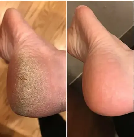 Häl före och efter med Lovelle Smooth Pro