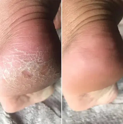 Min häl före och efter med Lovelle Smooth Pro