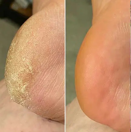 Häl före och efter med Lovelle Smooth Pro
